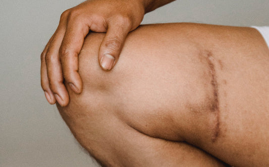 Reduce las cicatrices con remedios naturales